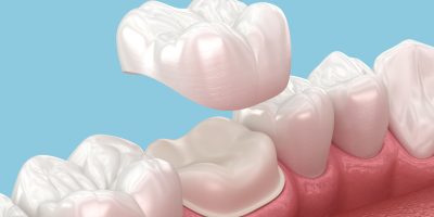 Dental crown placement over molar tooth. 3D illustration